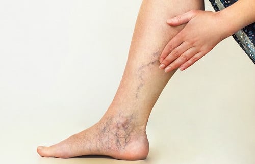 VEIN TREATMENTS - Dermatology Institute and Laser Center