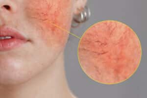 The Relationship Between H. Pylori & Rosacea