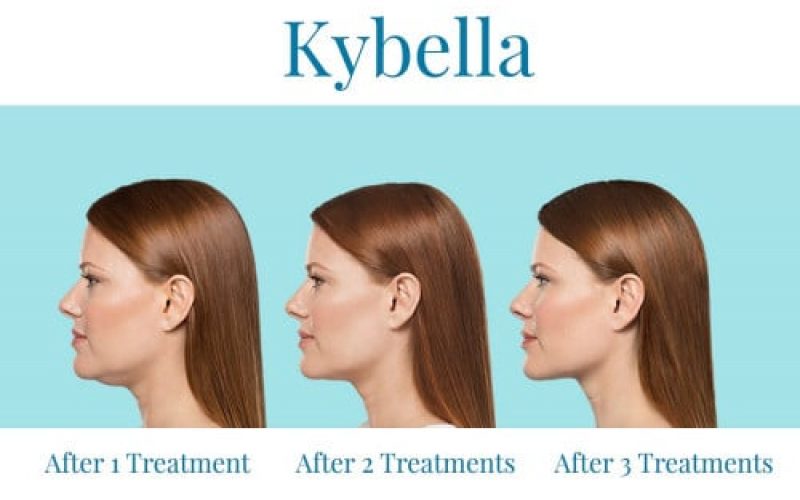 Kybella