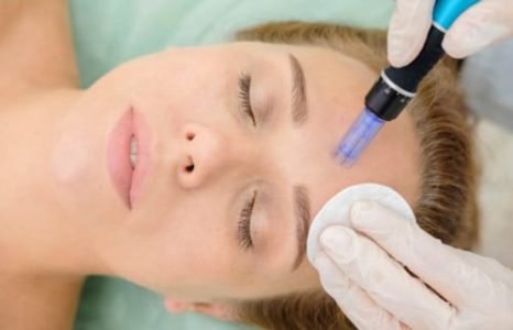 Microneedling