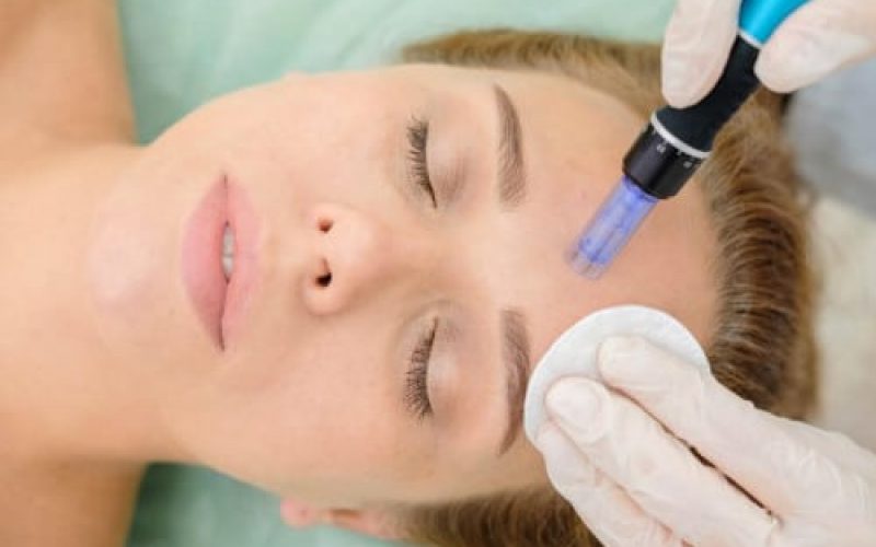 Microneedling