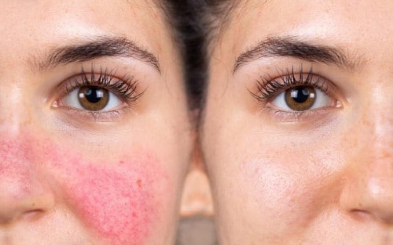 Rosacea